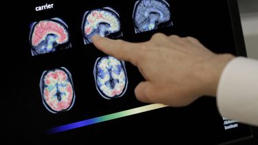 ARCHIVO - Un médico revisa una tomografía del cerebro en el Instituto Banner sobre Alzheimer en Phoenix, el 14 de agosto de 2018. (AP Foto/Matt York, archivo)