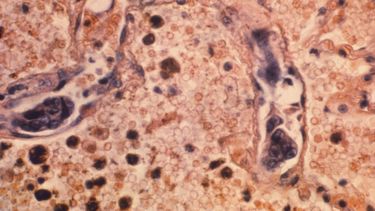 EEUU registra nueva caída récord en muertes por cáncer