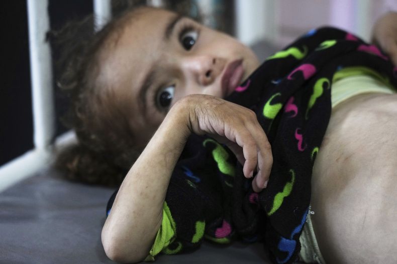 Mayar Al-Arja, un niño de 2 años que sufre de desnutrición, en el Hopsital Nasser de Jan Yunis en la Franja de Gaza el 21 de mayo del 2025. (AP Foto/Abdel Kareem Hana)