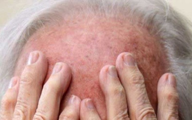 Investigaciones recientes prevén que esa enfermedad afectará a unos 270.000 cubanos para el año 2030.