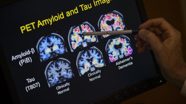 ARCHIVO - Un médico señala imágenes de un escáner cerebral dentro de un estudio sobre el Alzheimer en el hospital de la Universidad de Georgetown, el martes 19 de mayo de 2015 en Washington. (AP Foto/Evan Vucci, Achivo)