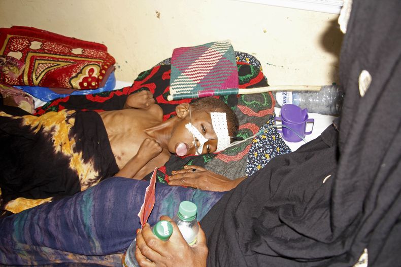 Una mujer atiende a su hijo desnutrido en el hospital Banadir el miércoles 14 de mayo de 2025, en Mogadiscio, Somalia. (AP Foto/Farah Abdi Warsameh)