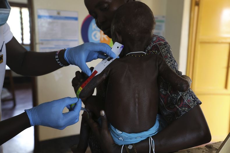Sunday Achok, de 14 meses, que sufre desnutrición aguda, es medido en el Hospital General Ammusait en Turkana, Kenia el miércoles 4 de junio de 2025. (AP Foto/Andrew Kasuku)
