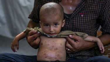 Mohammed Abu Obaid, un niño palestino que padece una enfermedad de la piel, posa para una fotografía junto a su padre en un campamento para desplazados por la guerra en Deir al-Balah, Franja de Gaza, el lunes 29 de julio de 2024. (Foto AP/Abdel Kareem Hana)
