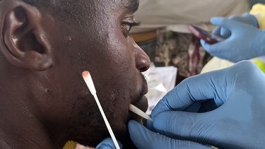 Patrick Bahati recibe tratamiento para el mpox en el hospital Miti Murhesa, a unos 25 kilómetros (5,5 millas) de Bukavu, República Democrática del Congo, el jueves 6 de marzo de 2025. (AP Foto/Janvier Barhahiga)