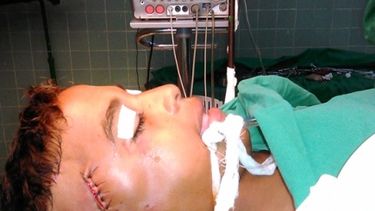 Niño cubano sobrevive a arponazo que le atravesó la cabeza