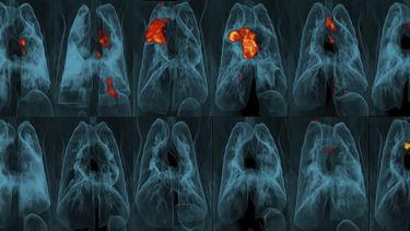 Estudio: Vacuna contra tuberculosis es mejor intravenosa