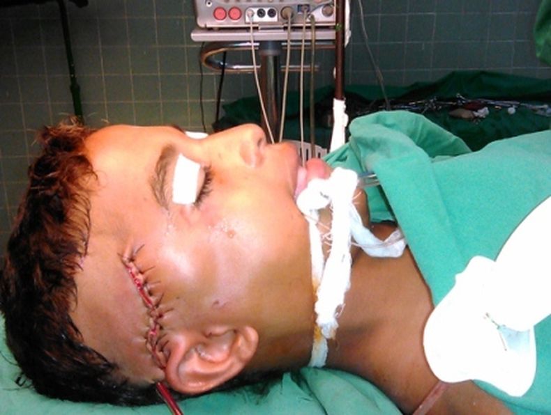 El adolescente de 15 años, residente en el oriente del país, sobrevivió a la horrible experiencia de tener alojado en su cabeza durante varias horas un arpón de pesca de 60 centímetros de largo.