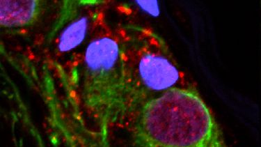 Estudio: Posible vínculo entre apéndice y mal de Parkinson