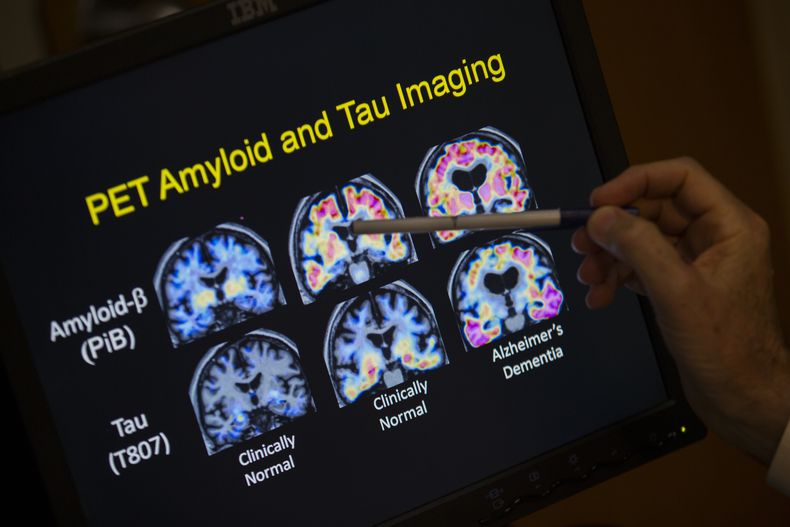 ARCHIVO - Un médico señala imágenes de un escáner cerebral dentro de un estudio sobre el Alzheimer en el hospital de la Universidad de Georgetown, el martes 19 de mayo de 2015 en Washington. (AP Foto/Evan Vucci, Achivo)