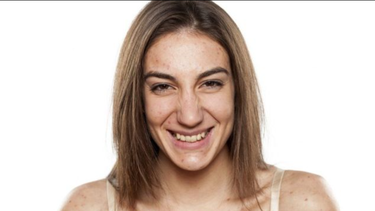 ¿por que haber tenido acne puede retrasar el envejecimiento de la piel?