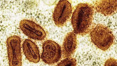 ARCHIVO - Esta imagen de microscopio electrónico coloreada proporcionada por el Instituto Nacional de Enfermedades Alérgicas e Infecciosas de Estados Unidos (NIAIS, por sus siglas en inglés), en 2024, muestra partículas del virus de la viruela símica, de color naranja, que se encuentran dentro de células infectadas, de color verde. (NIAID vía AP, Archivo)