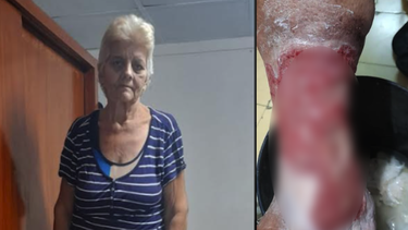 cubana lleva casi dos decadas con una ulcera en el pie y no le encuentran tratamiento